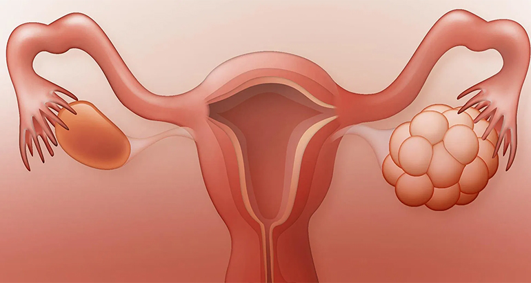 PCOS Clinic